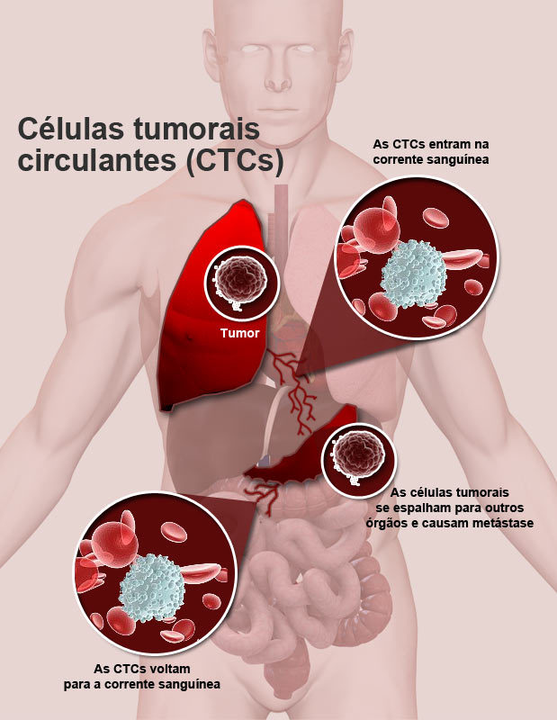 Células tumorais circulantes (CTCs)