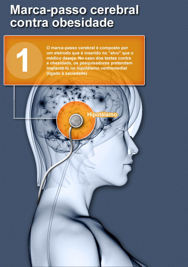 Marca-passo cerebral contra obesidade  Ilustrações: Getty Images - Fábio Condutta/Terra