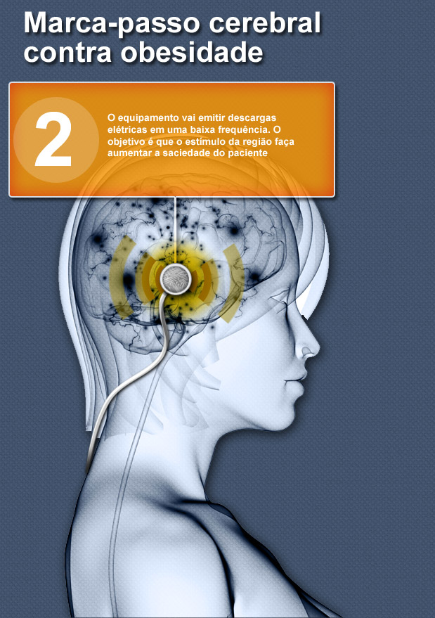 Marca-passo cerebral contra obesidade  Ilustrações: Getty Images - Fábio Condutta/Terra