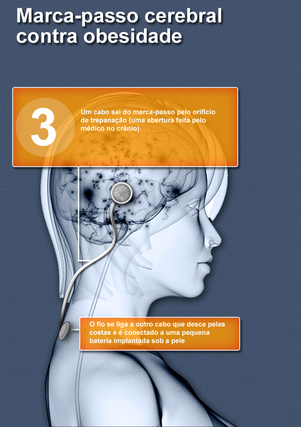 Marca-passo cerebral contra obesidade  Ilustrações: Getty Images - Fábio Condutta/Terra